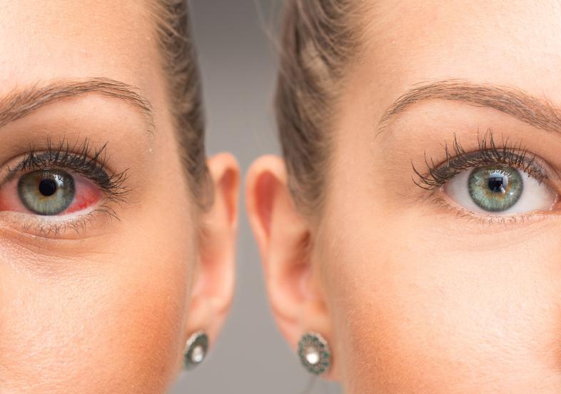 Woman with red, dry eye